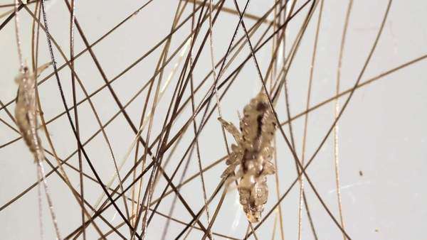 Head Lice Pediculus Humanus Capitis Clambering Through Human
