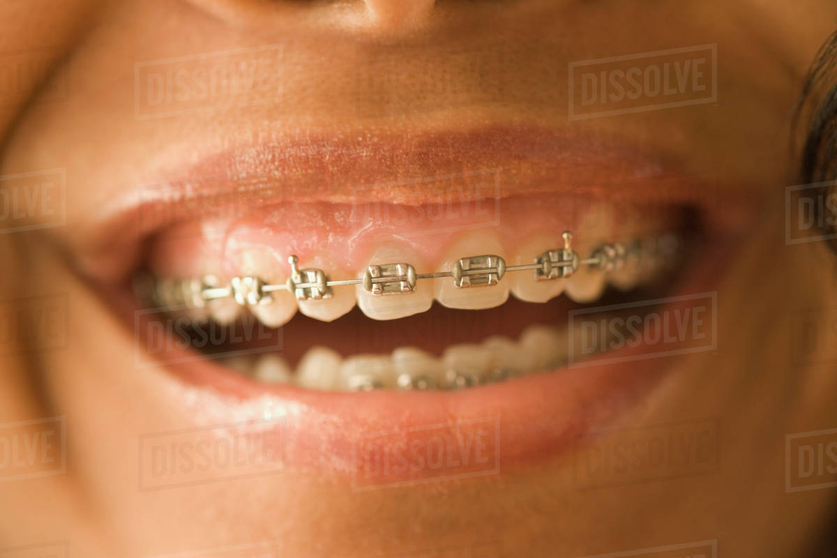 Close up of African woman with orthodontic braces Stock Photo Dissolve