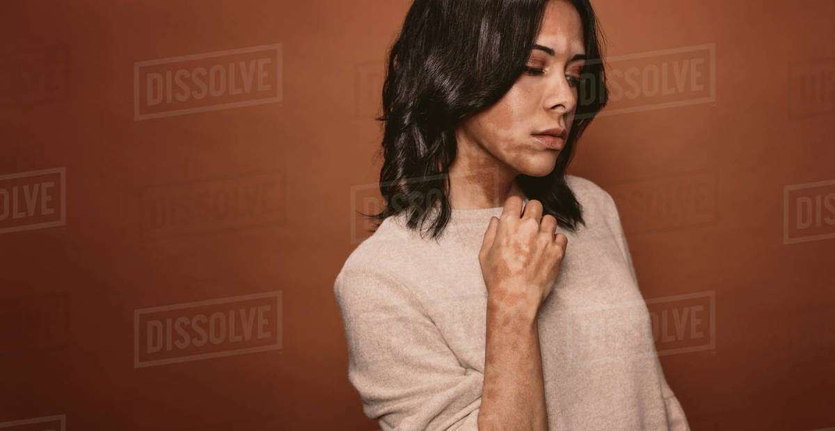 Vitiligo affected young woman in studio. Female with bad tan problem standing on brown