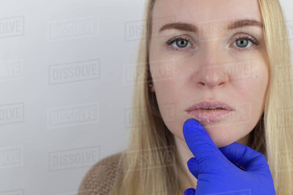 A woman examines dry skin on her lips. Peeling, coarsening,