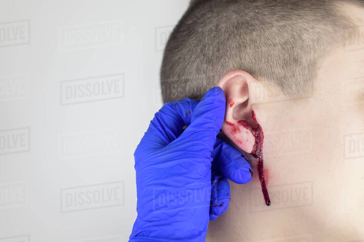 A man whose ear is bleeding. Vascular rupture, damage to the tympanic