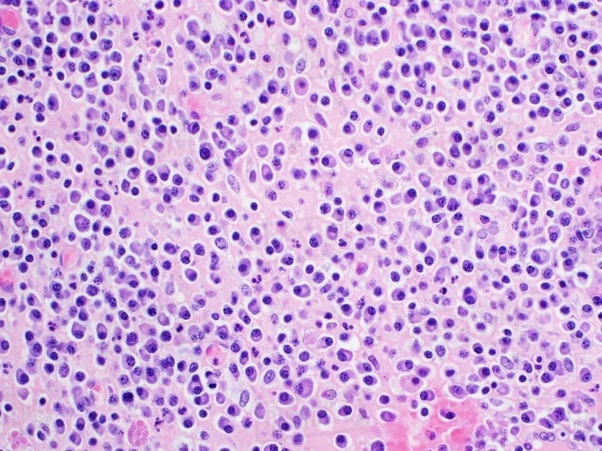 H&E stain, light microscopy, multiple myeloma Stock Photo Dissolve