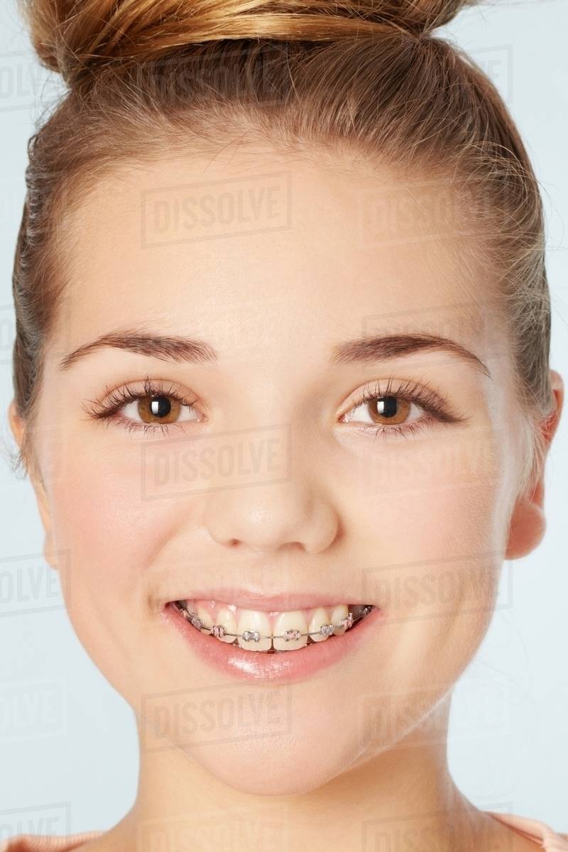 Close up of smiling girl in braces Stock Photo Dissolve